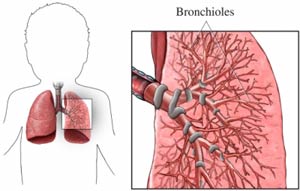 التهاب نایژک‌ها یا برونشیولیت Bronchiolitis