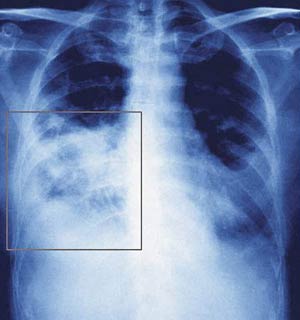 ذات‌الریه Pneumonia