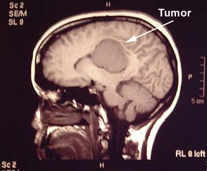تومور مغزی‌ و راهکارهای درمان آن