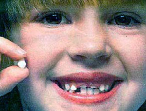 عمر دندانهای شیری تا ۱۲ سالگی است