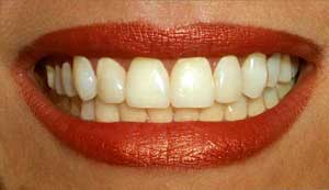 تفاوت دندانهای طبیعی و مصنوعی از نظر تحمل نیرو