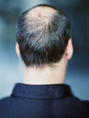 نگهداری و جلوگیری از ریزش موی سر