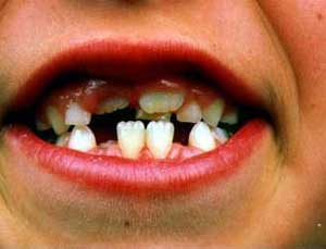 سه اتفاق محتمل برای مادر که می‏تواند دندانهای طفل را مستقیما تحت تاثیر قراردهد