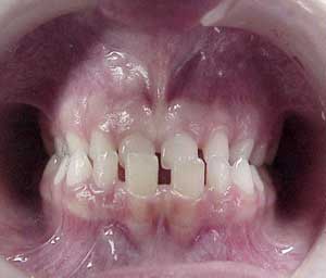 دندانهای فک جوش