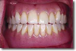 مشکلات دندان مصنوعی