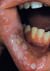 تعیین میزان شیوع باکتری های بی هوازی اجباری در عفونت های حفره دهان