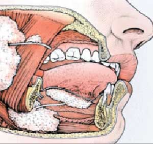 چاره‌جویی برای خشکی دهان