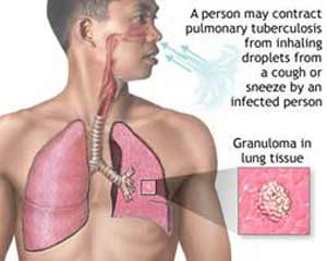 سل ( Tuberculosis) چیست ؟