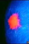 بررسی حساسیت و ویژگی نشانگر CA ۱۵-۳ در عود سرطان پستان