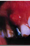 بررسی میزان شیوع انواع آبسه های دندانی در کودکان مبتلا به آبسه دندانی مراجعه کننده به بخش کودکان دانشکده دندانپزشکی مشهد در سال ۱۳۸۲