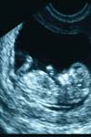 تعیین وزن جنین با سونوگرافی در خانمهای باردار با حاملگی ترم
