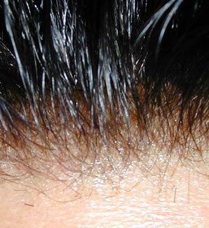 برای جلوگیری از ریزش مو چه باید خورد؟