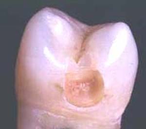 پوسیدگی دندان و علل آن