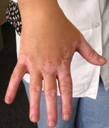 بیماری ویتیلیگو (vitiligo) چیست ؟