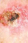 بروز Non melanoma skin cancer در استان اصفهان