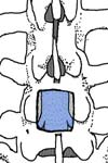 پیامد وسیله گذاری قطعه کوتاه در شکستگی چند تکه ای ناحیه پشتی- کمری