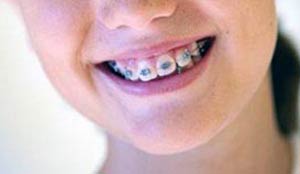 براکت‌های دندانی