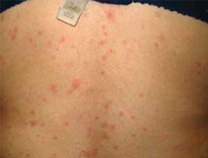 بیماری شبه‌آنفلوآنزا همراه با بثورات پوستی