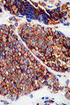 تومور نورواکتودرمال بدخیم محیطی یک مورد نادر