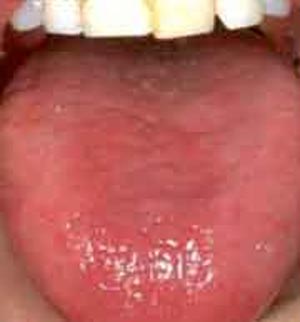 التهاب و قرمز شدن‌ زبان‌ (گلوسیت‌)tongue inflammation