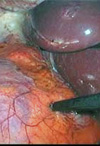 گزارش یک مورد تومور تخمدان با متاستاز به غده آدرنال