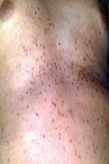 Eruptive vellus hair cyst: گزارش دو بیمار خانوادگی در ناحیه صورت