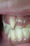 بررسی تغییرات سفالومتریک (دندانی اسکلتی) در بیماران Cl III در دوره دندانی مختلط متعاقب استفاده از دستگاه Face mask
