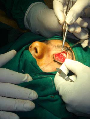 پروبینگ و شستشوی مجرای اشکی با میتومایسین در درمان انسداد مجرای اشکی بالغین