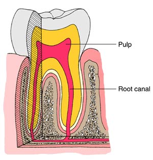 نکاتی راجع به پوسیدگی دندان