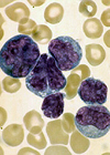 گزانتوم منشر نرمولیپیدمیک در بیمار مبتلا به Adult T-cell Lymphoma/Leukemia: گزارش یک مورد