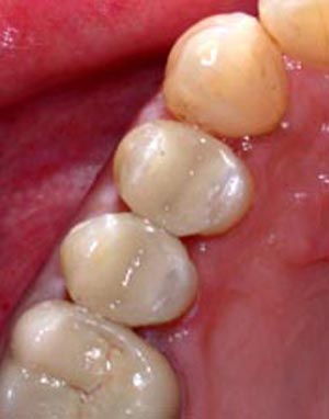 ترمیمهای دندان