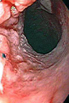 عوامل خطر سرطان مری و ارتباط آن با مکان های مختلف آناتومیک مری در درمانگاه گوارش ارس اردبیل