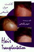 کاشت مو = Hair transplantation