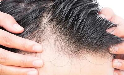 اگر ریزش مو دارید این خبر را بخوانید| این ۵ ماده شما را از ریزش مو نجات می‌دهد
