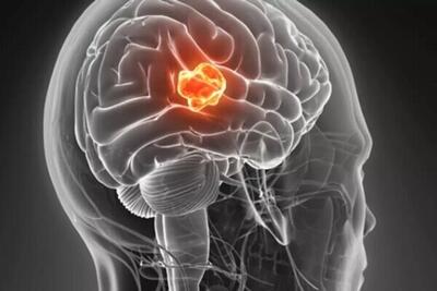 واکسن MRNA با تومور مرگبار مغز مبارزه می کند