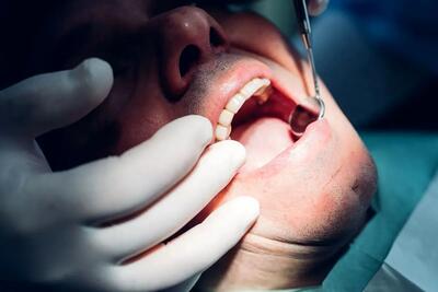 دندان عقل را باید کشید؟ | اقتصاد24