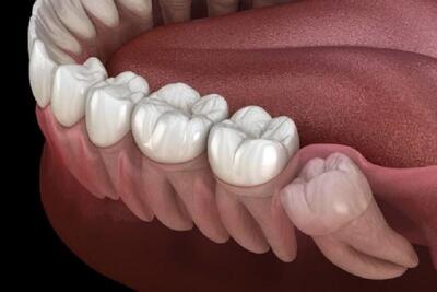 کشیدن دندان عقل برای چه کسانی ممنوع است؟ | آیا کشیدن دندان عقل سلامت فرد را به خطر میاندازد؟