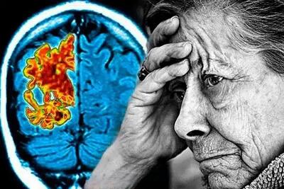 چرا آلزایمر در زنان بیشتر دیده می شود؟