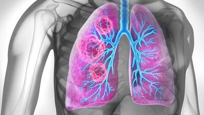 گزارش جدید محققان؛  ایمونوتراپی قبل و بعد از جراحی بقای سرطان ریه را افزایش می دهد