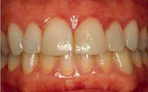 ازدیاد حساسیت دندان