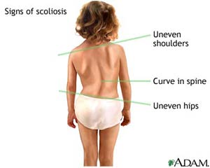 ستون مهره‌ها (خمیدگی طرفی) Scoliosis