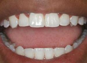 دندان‌های جایگزین