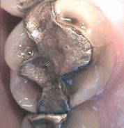 مسمومیت با جیوه در اعمال دندانپزشکی