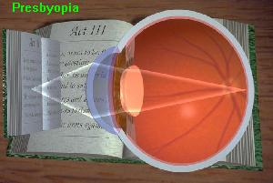پیر چشمی Presbyopia