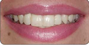 چرابعضی دندانها سفید و بعضی زرد رنگ هستند؟