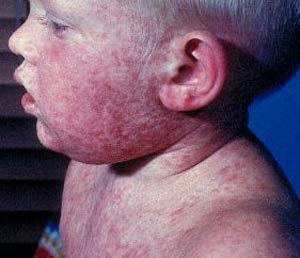 سرخک Measles
