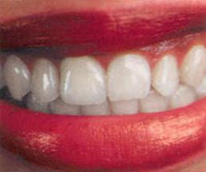 دندان مصنوعی ا ز چه زمانی متداول شد؟