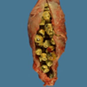 سنگ‌ کیسه‌ صفرا‌(gallstones)