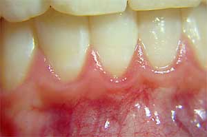 بیرون آوردن دندانها چه تأثیری روی استخوان فکین دارد؟