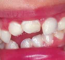 عادات دهانی کودکان و ناهنجاری های دندانی فکی